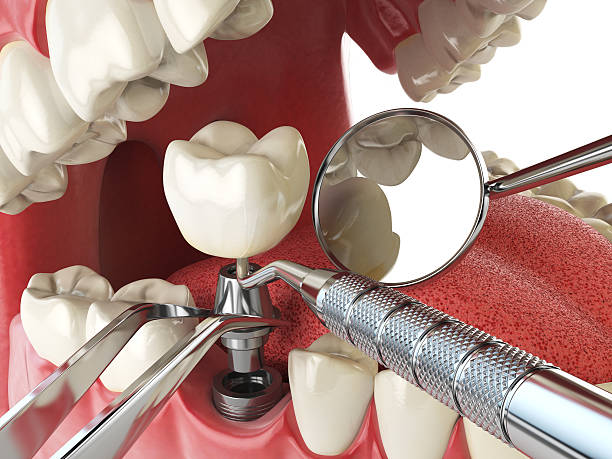 Best Emergency Root Canal Treatment in Easton, CA